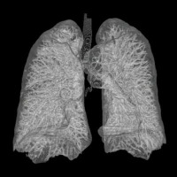 CT Bild Lunge